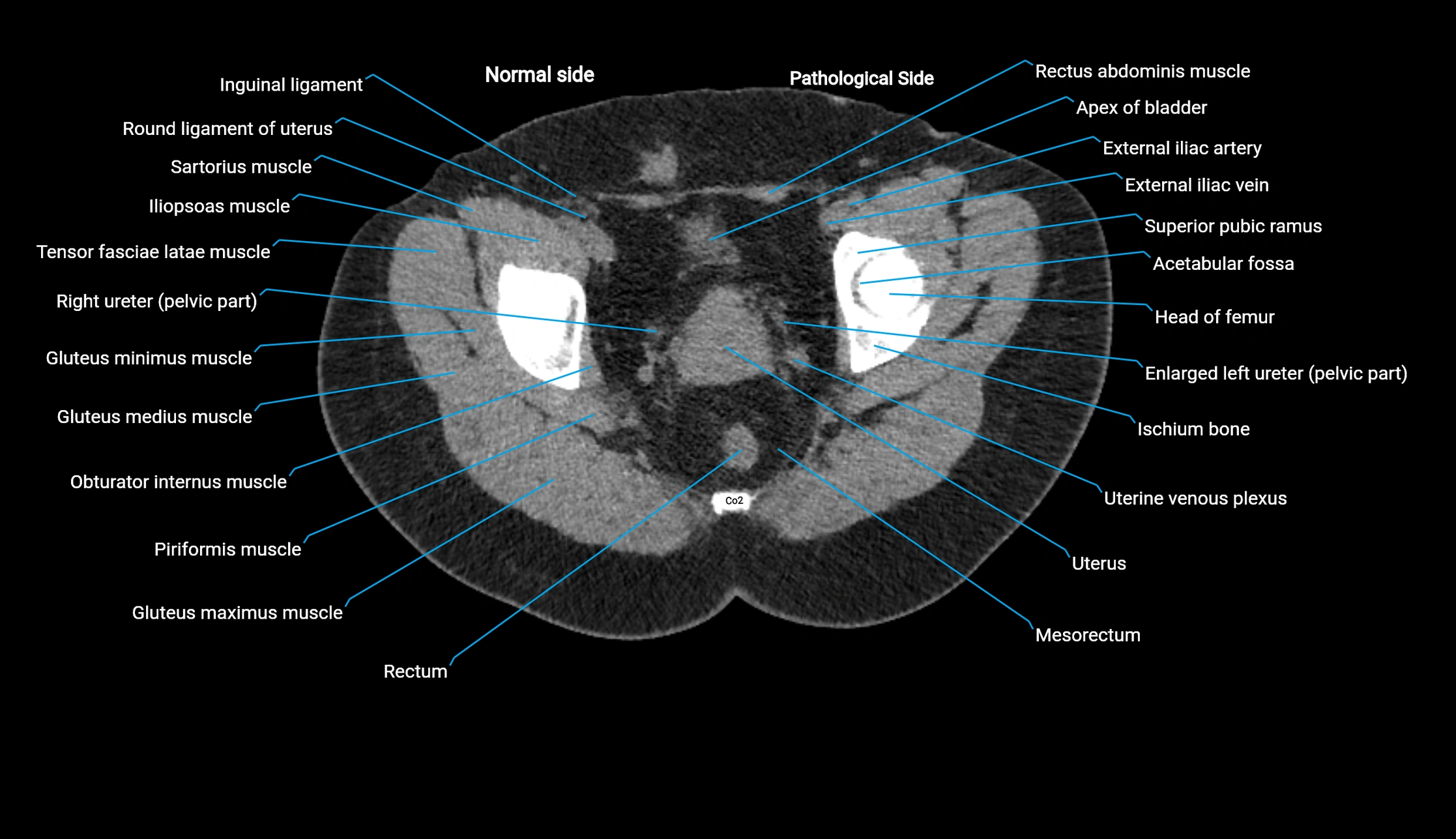 CT KUB axial cross sectional anatomy  radiology image -img-00201-00152.webp